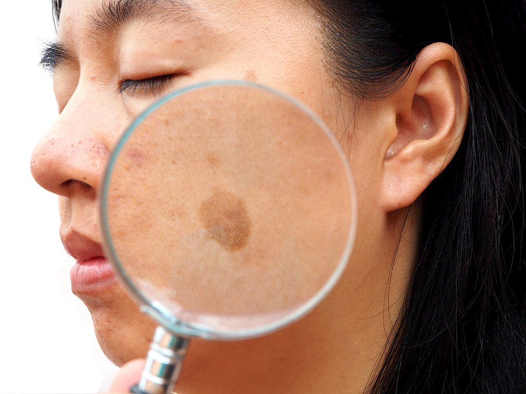 Melasma syntyy usein poskelle tai otsalle, nenänvarteen ja ylähuulen seutuun.