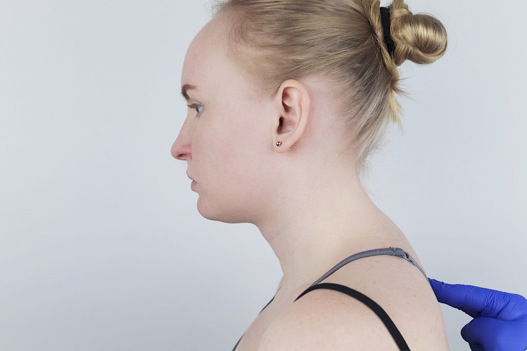 Kyphosis. The woman suffers from a curvature of the spine in the upper section. The cervical vertebrae bulge out and form a hump. Curvature and incorrect posture treatment concept