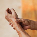 Nivelpsoriasis – kun psoriaasi iskee niveliin
