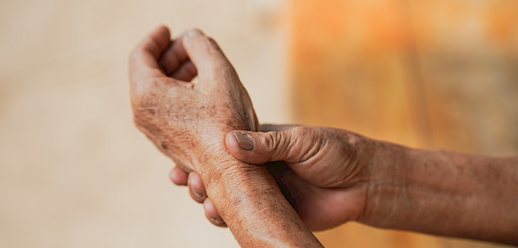 Nivelpsoriasis – kun psoriaasi iskee niveliin
