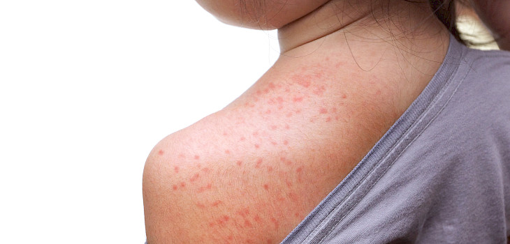 Vauvarokko on yleinen kuumeen ja ihottuman aiheuttaja pienillä lapsilla