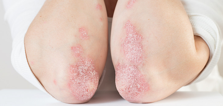 Psoriasis – mitkä ovat oireet ja miten sairaus todetaan?