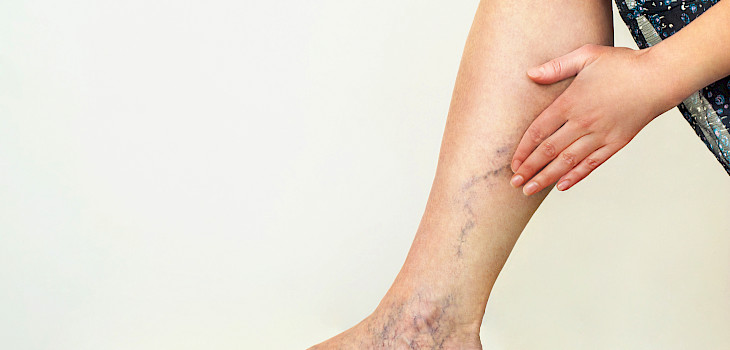 Syvä laskimotukos kehittyy usein huomaamatta – näin tunnistat sen