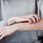 Ihottuma, joka ei parane - pitäisikö mennä lääkäriin?