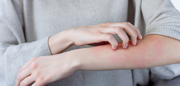 Ihottuma, joka ei parane - pitäisikö mennä lääkäriin?