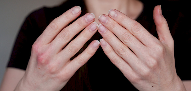 Käsien voimattomuus tai kömpelyys – milloin syy pitää selvittää?