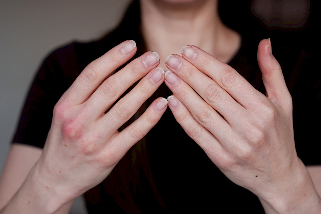 Missä vaiheessa käsien voimattomuus voi olla oire jostain vakavammasta?