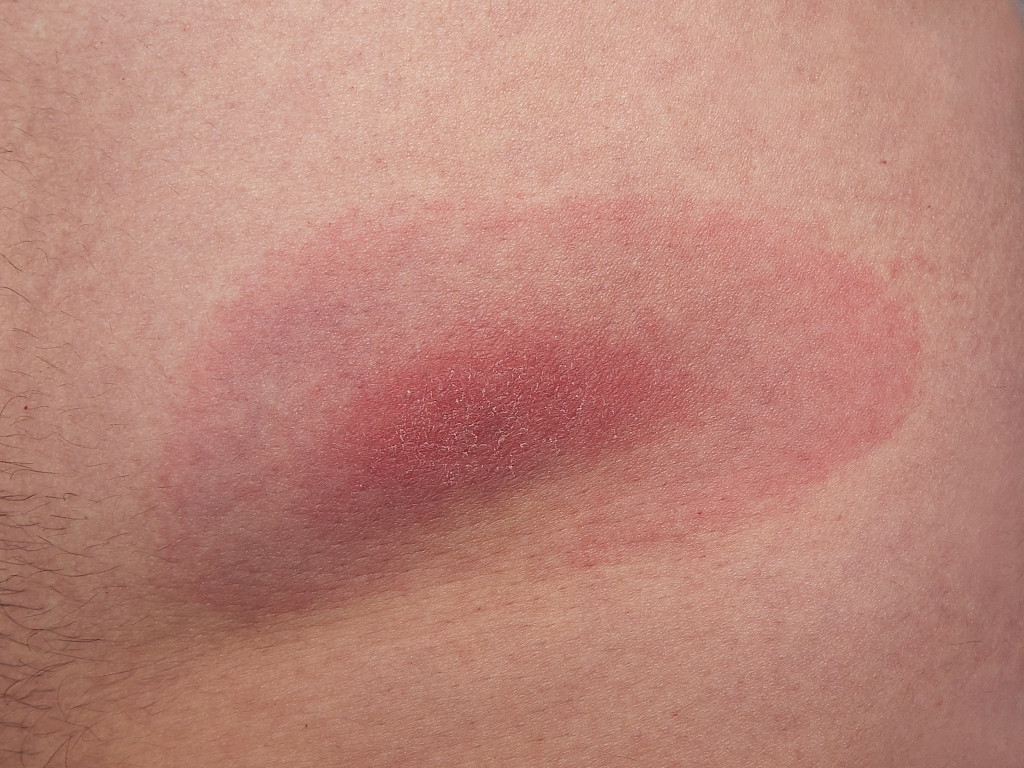 Borrelioosin aiheuttama ihomuutos voi olla rengasmainen, mutta se voi olla myös tasaisen punainen.